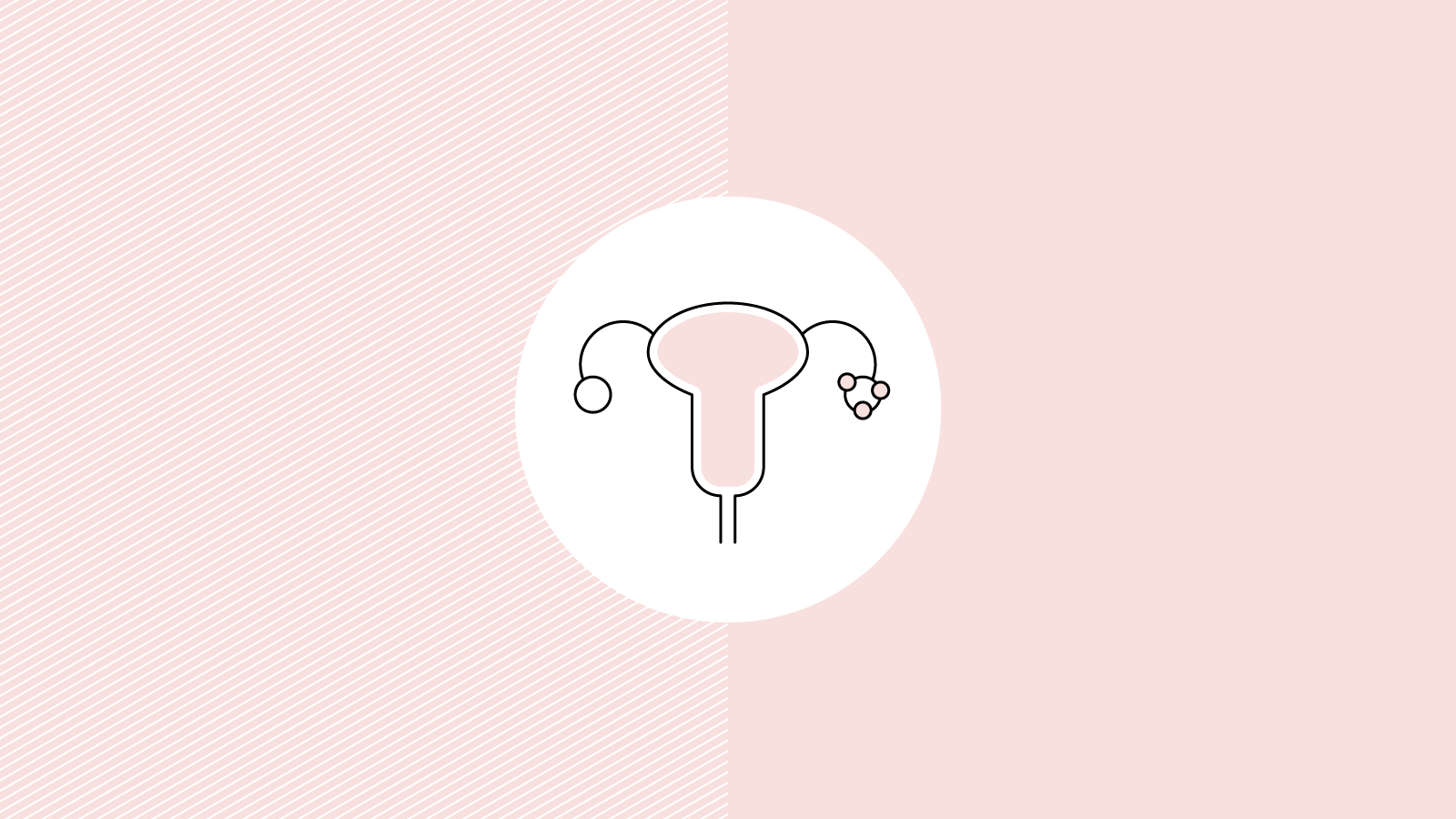 Does laser hair removal work for PCOS