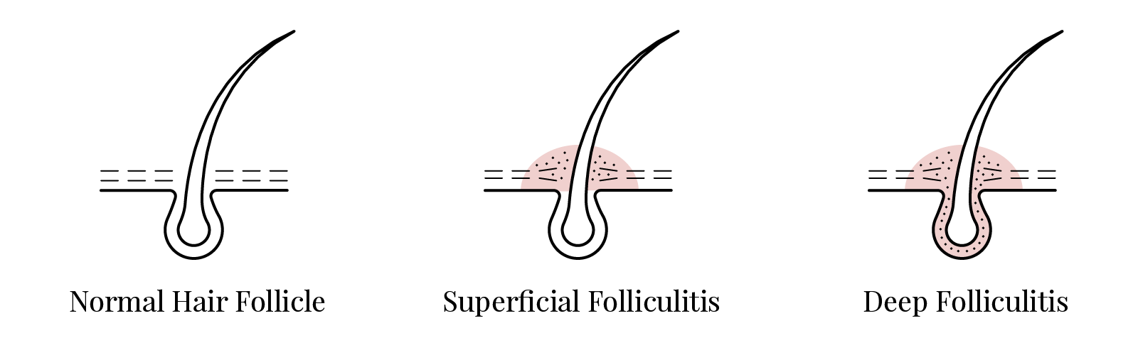 What Is Folliculitis?