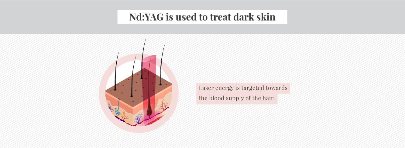 How Nd YAG works on Dark skin for laser hair removal