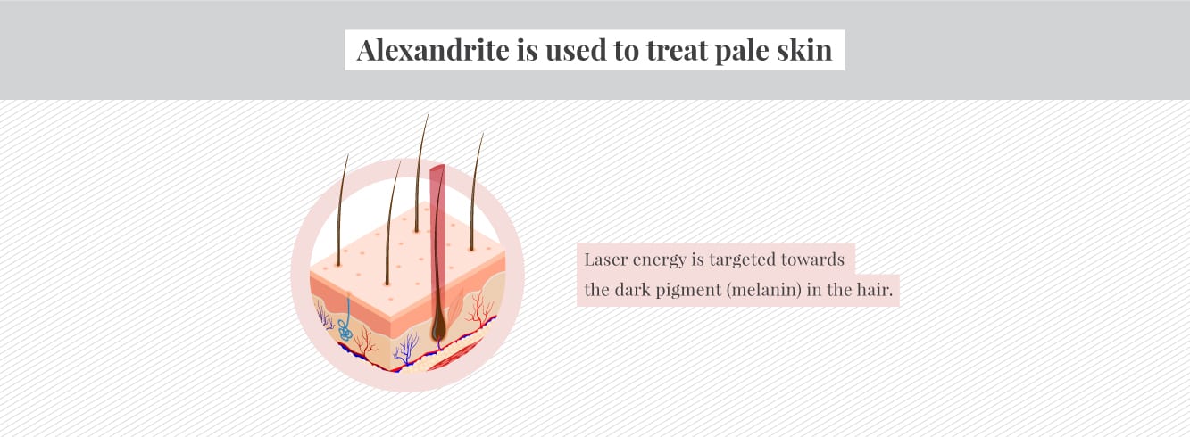 How Alexandrite laser treats pale skin