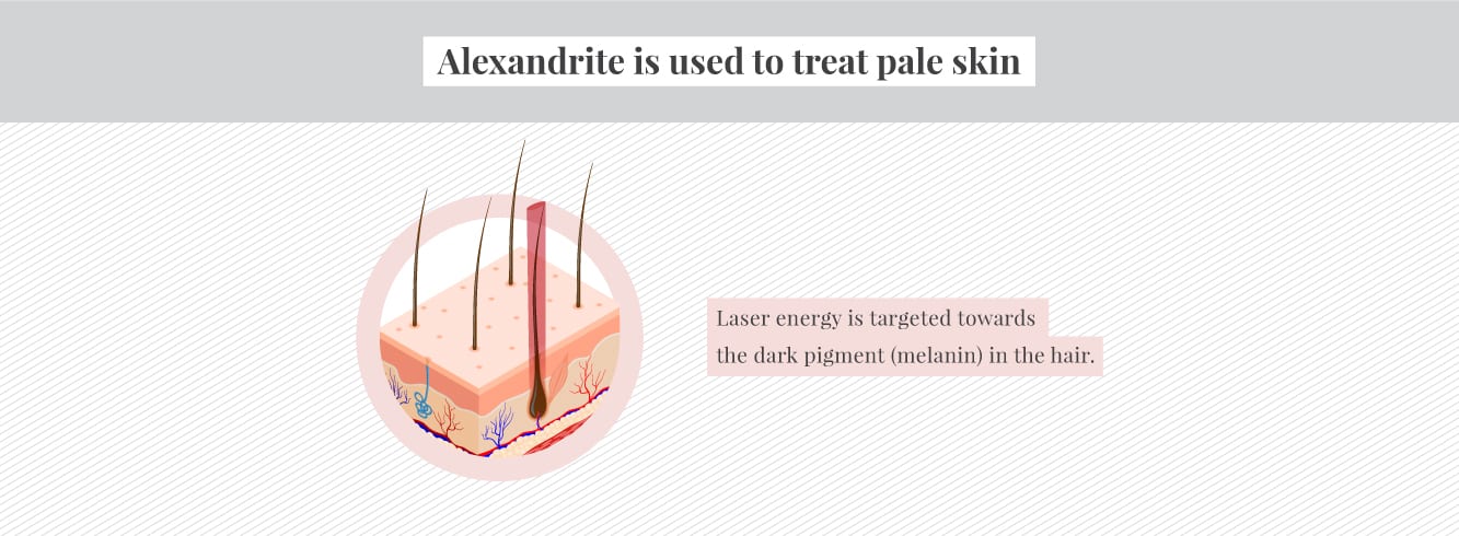 How Alexandrite laser treats pale skin 