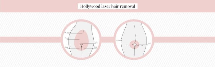 Laser hair removal hollywood results Clearance