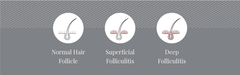 Superficial to deep folliculitis