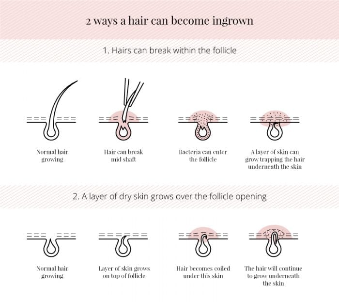 How a hair becomes ingrown
