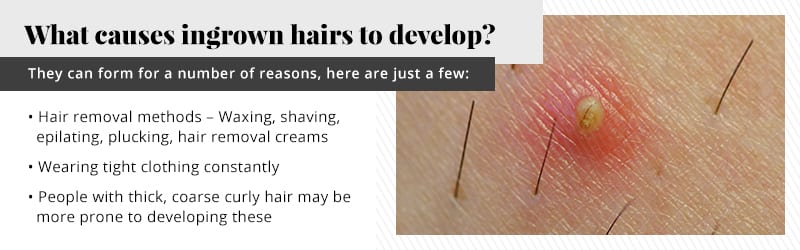 Resons why hairs become ingrown