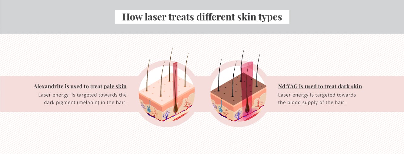 How laser treats different skin types 