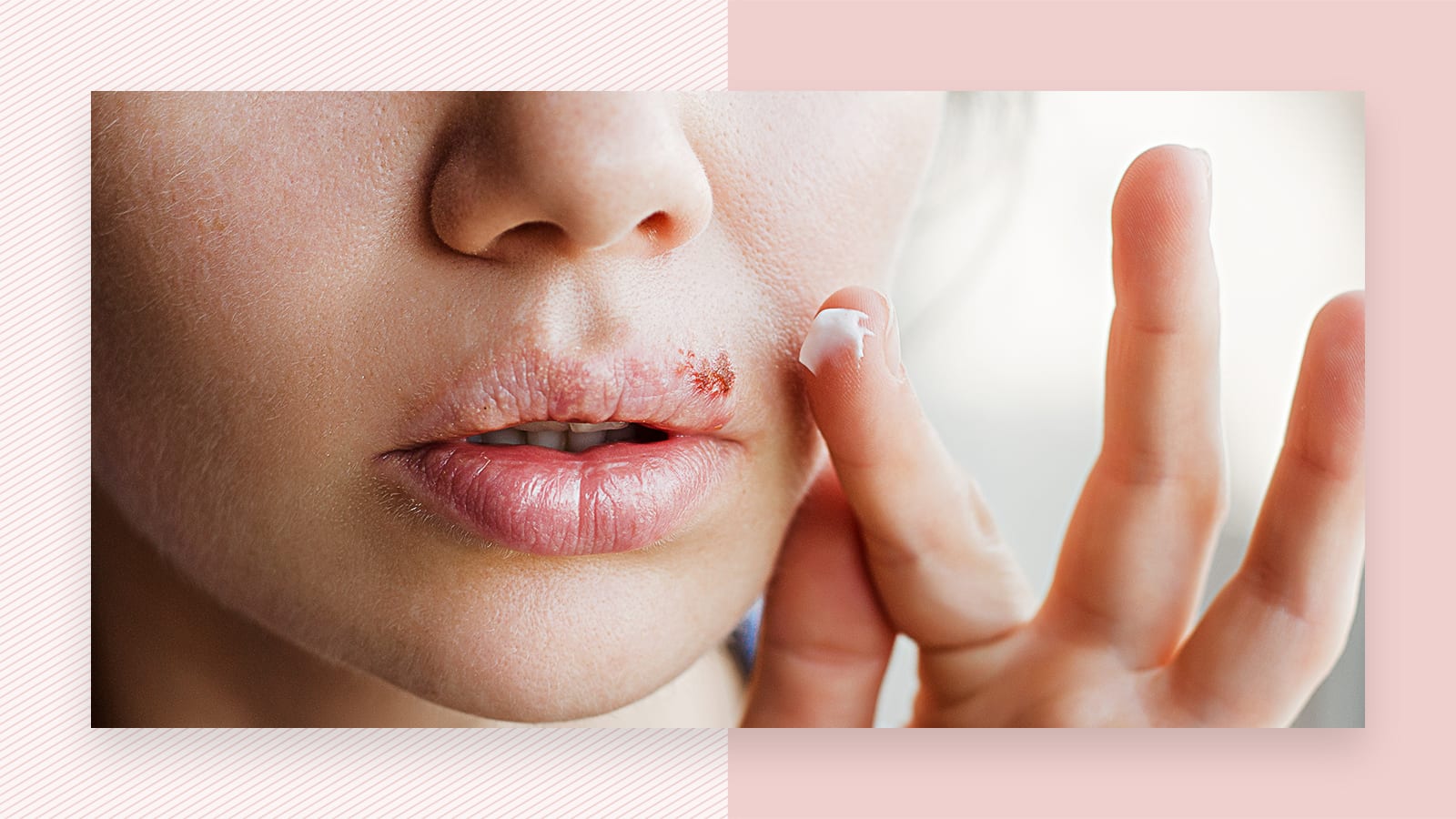 Can you have facial laser hair removal if you have a cold sore? - | Urbana