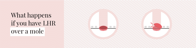 What would happen if moles are lasered