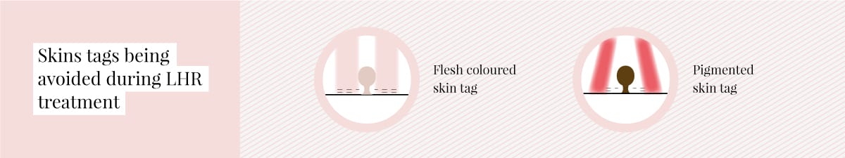 Darker skin tags need to be avoided during treatment 