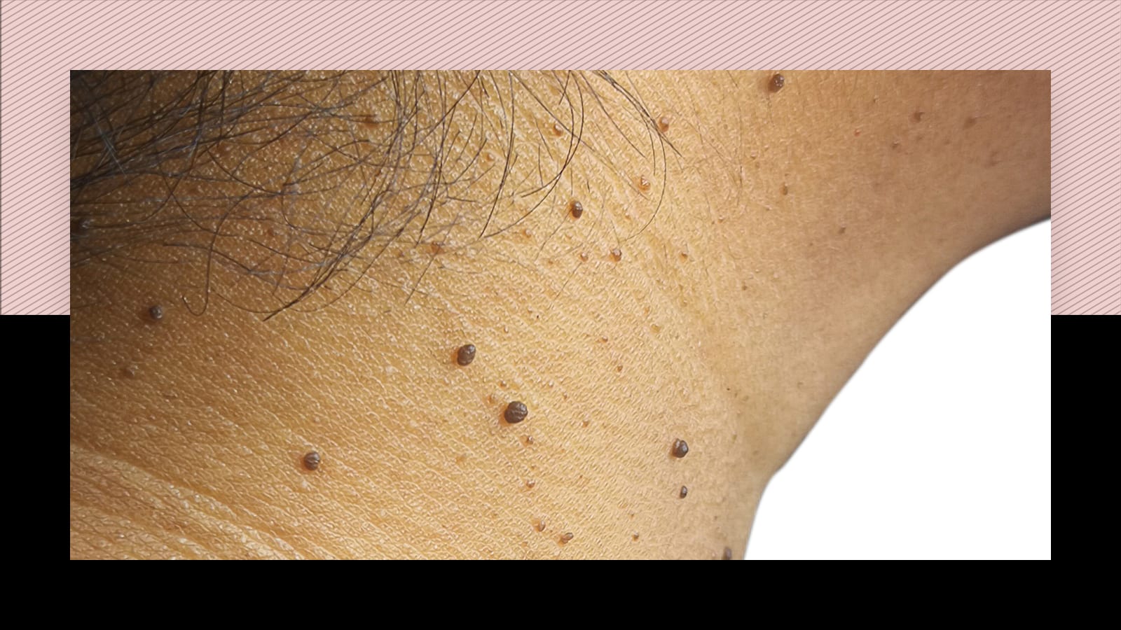 Is it safe to have laser hair removal if you have skin tags