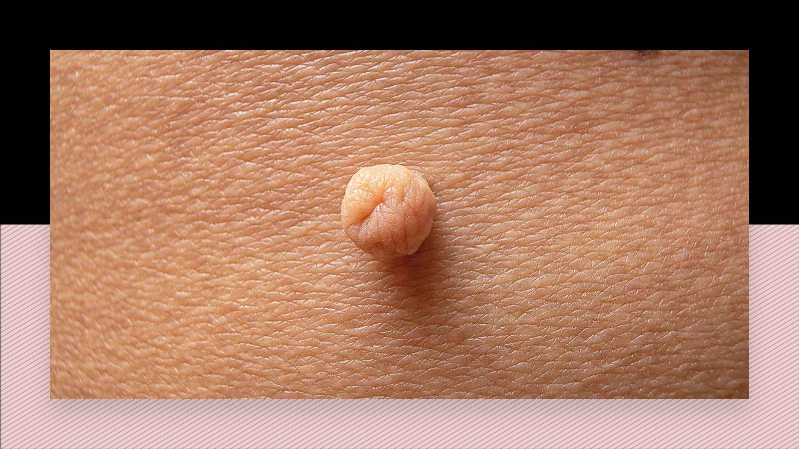 Skin tags and laser hair removal