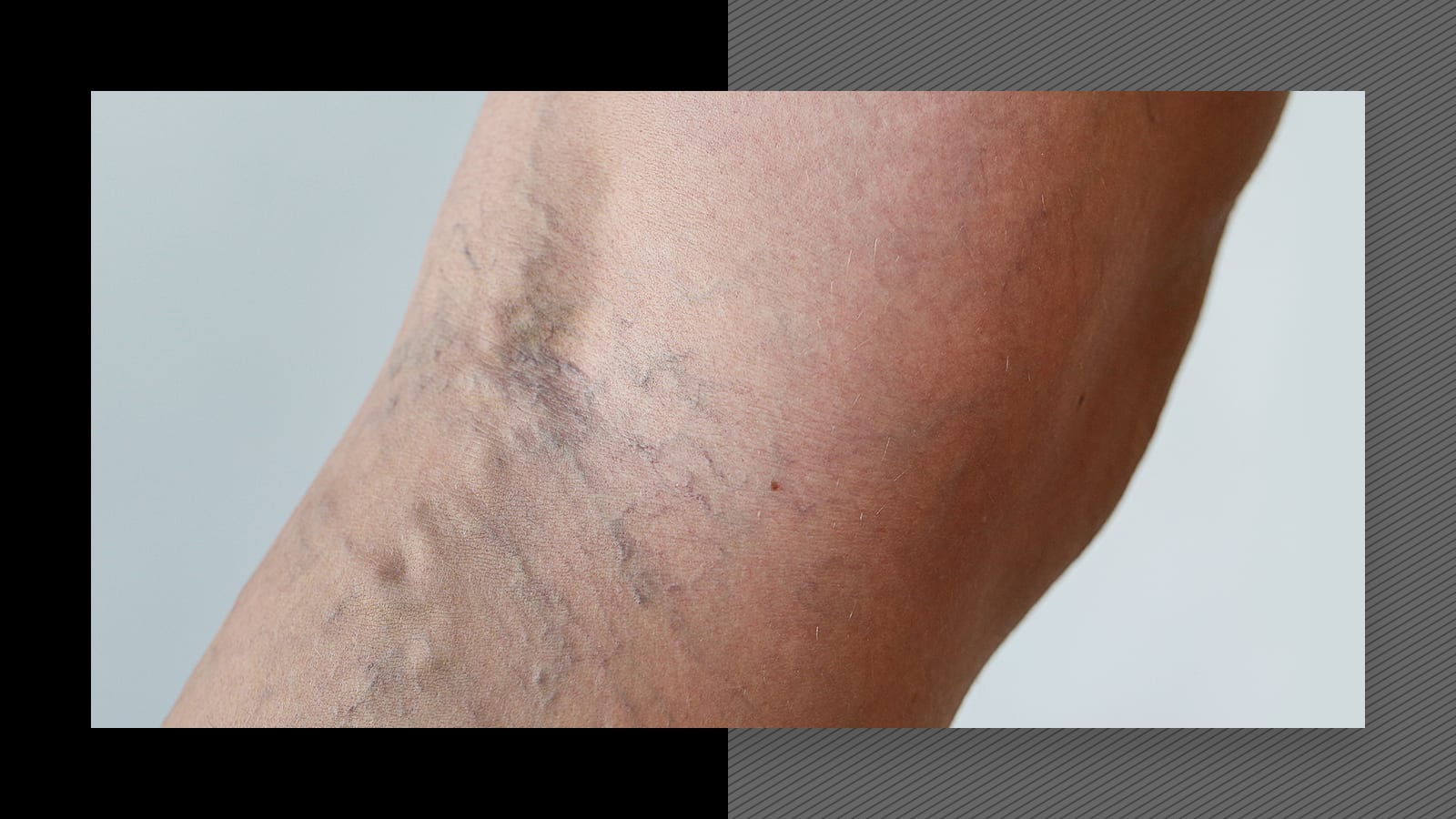 Can you have laser hair removal if you have varicose veins