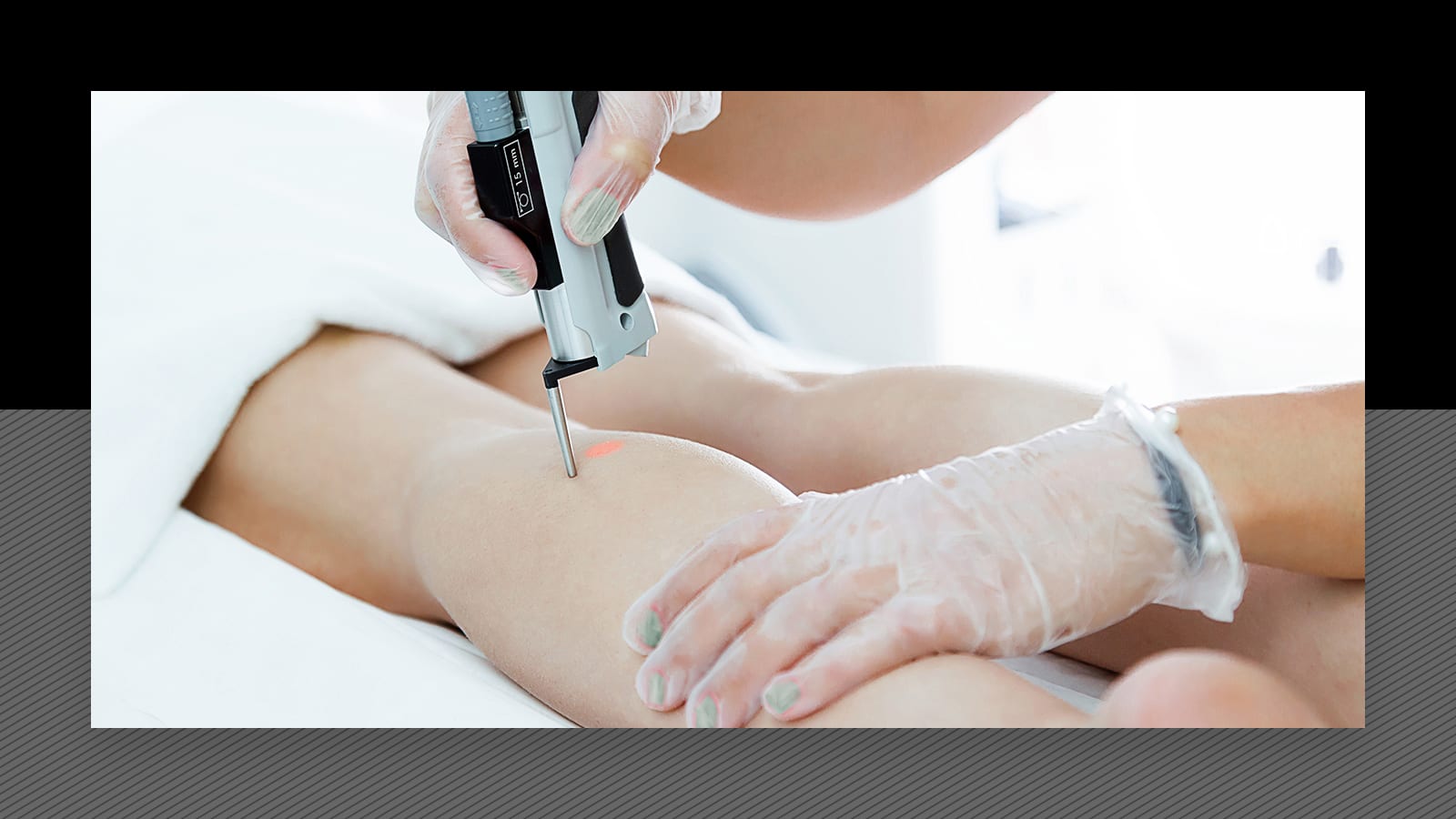 Is it safe to laser over varicose veins