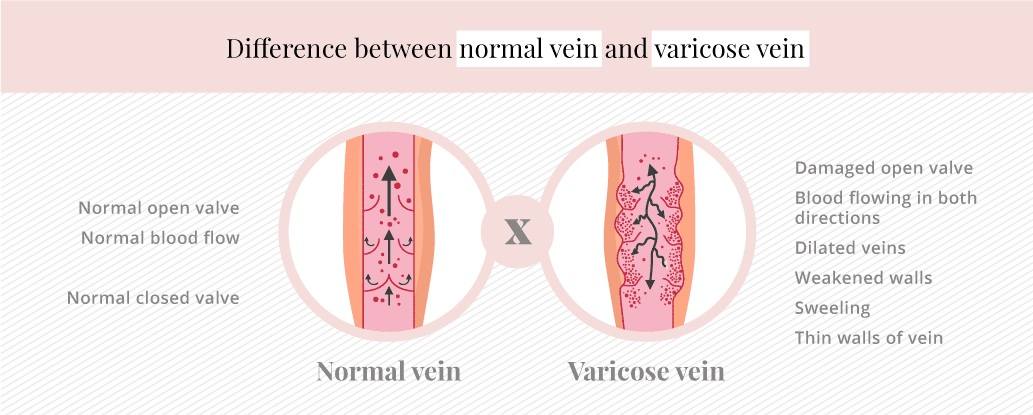 Varicose vein and laser hair removal