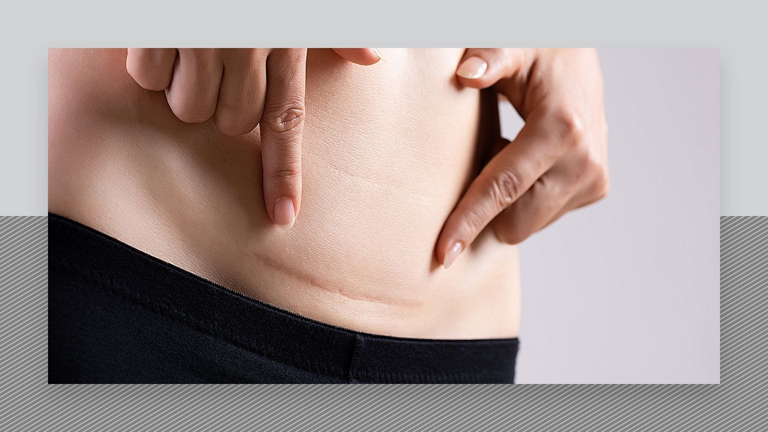 Caesarean section scars and laser hair removal Urbana