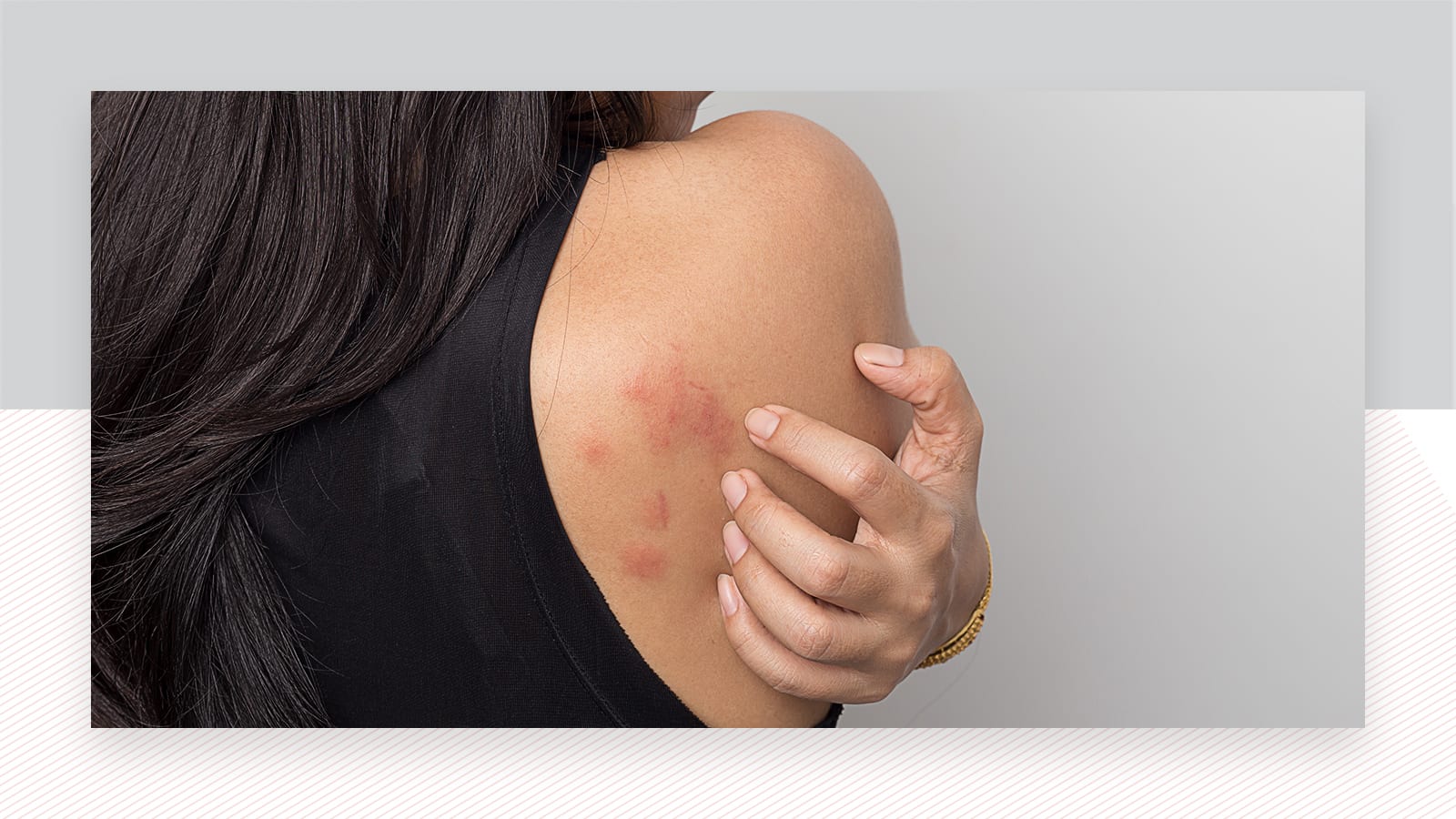 Follicular Eczema Treatment Causes Symptoms  More