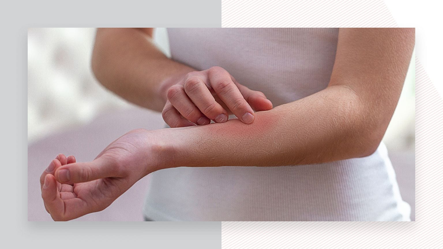 Eczema and laser hair removal Urbana