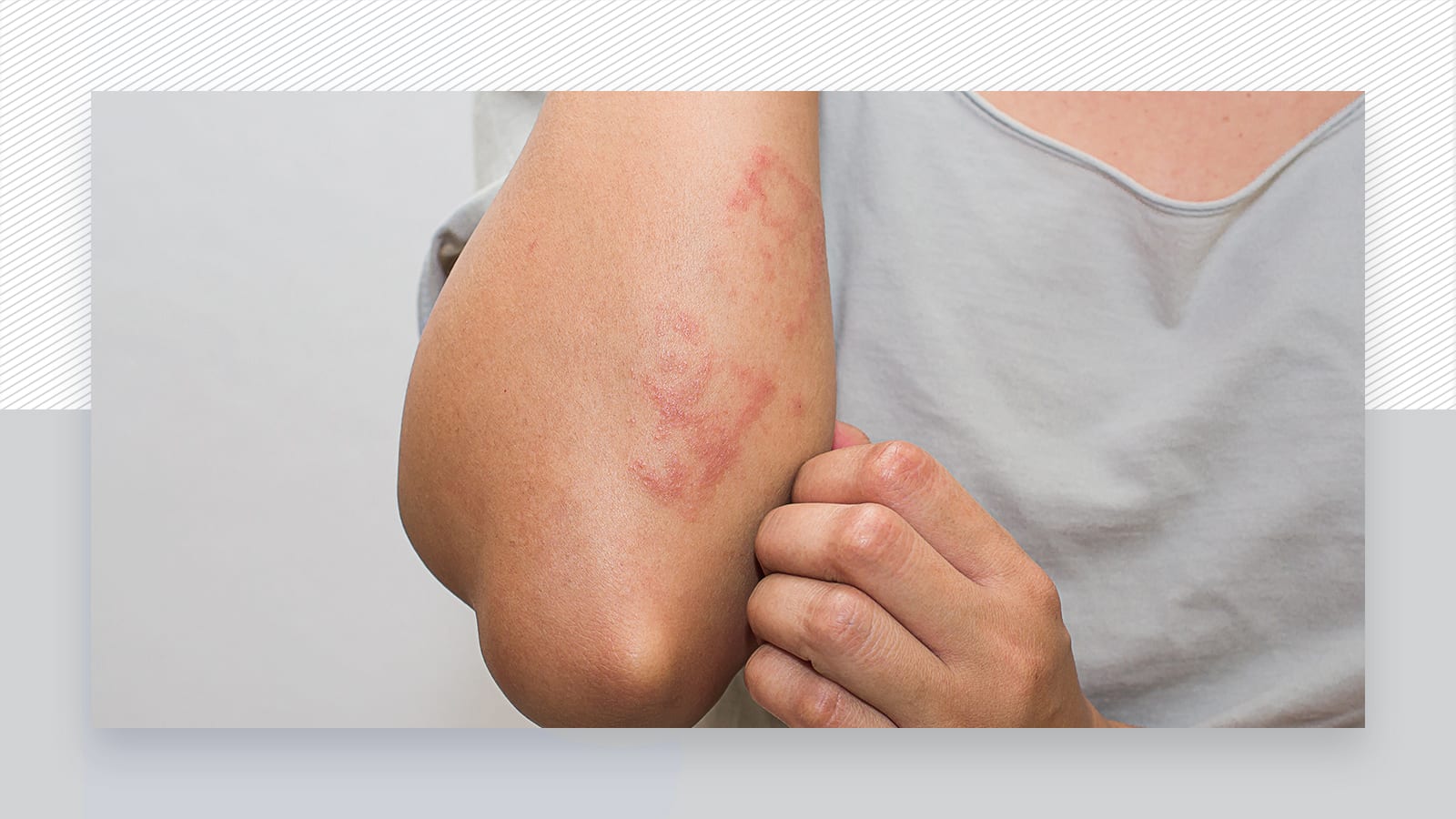Yes you can have laser if you have eczema