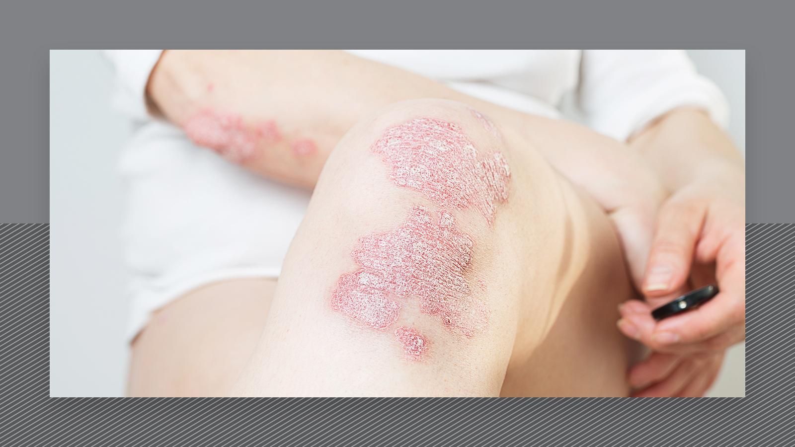 Is it safe to have laser hair removal when you have psoriasis
