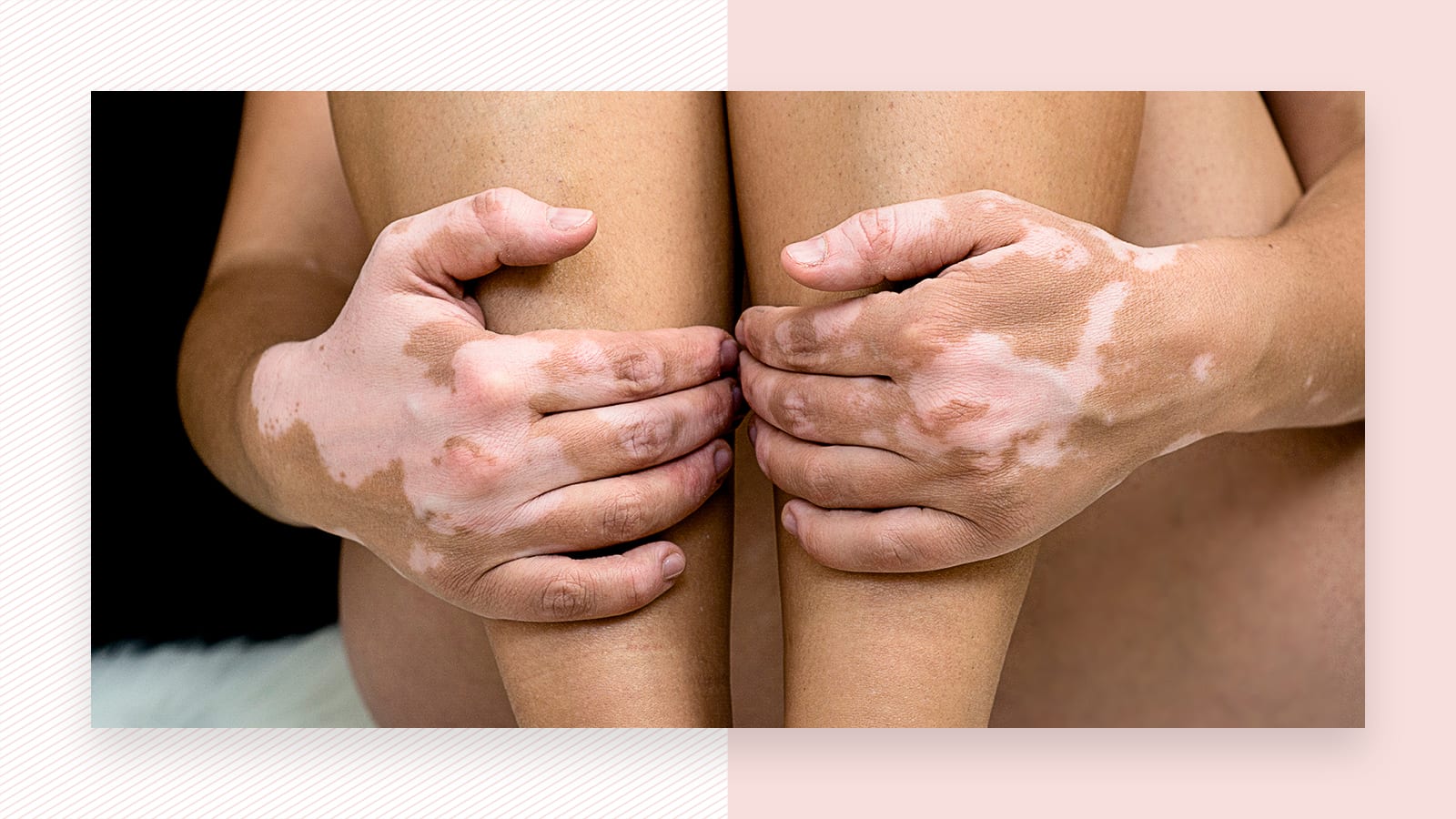 Is it safe to have laser hair removal when you have vitiligo