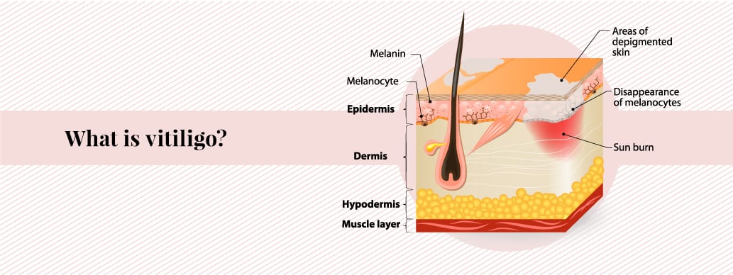 Is it safe to have laser hair removal if you have vitiligo