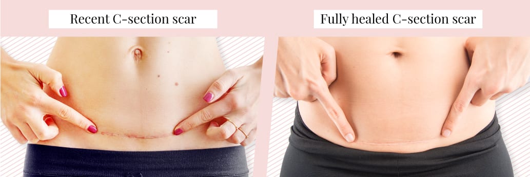 Is it safe to laser over a C-section scar? Is it safe to laser over a C-section scar?