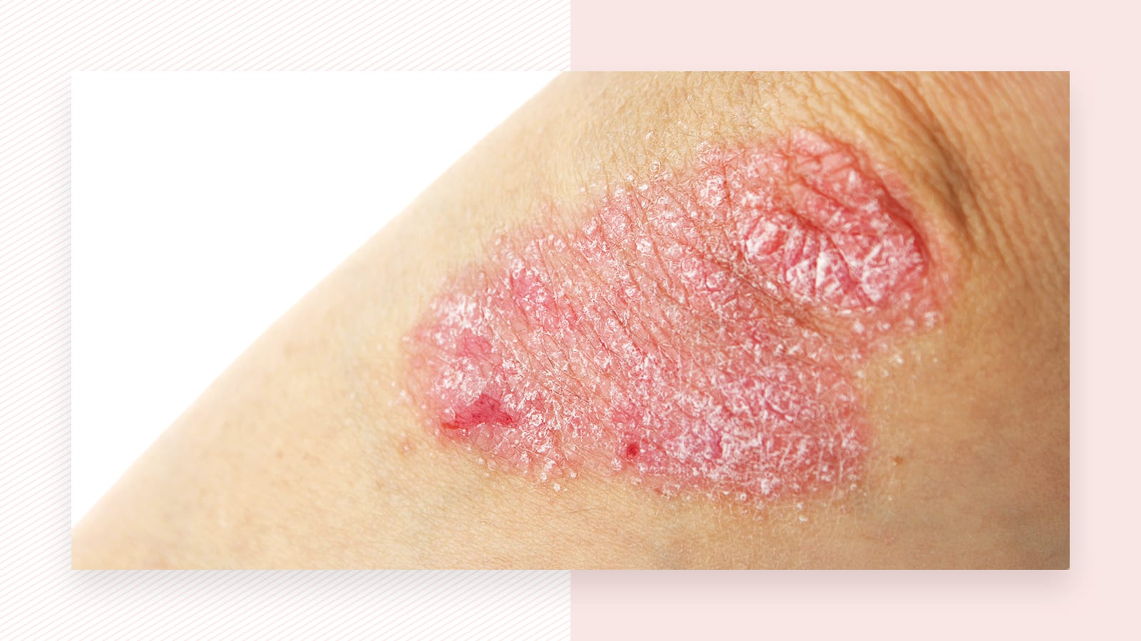 Psoriasis and laser hair removal