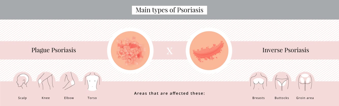 Types of psoriasis