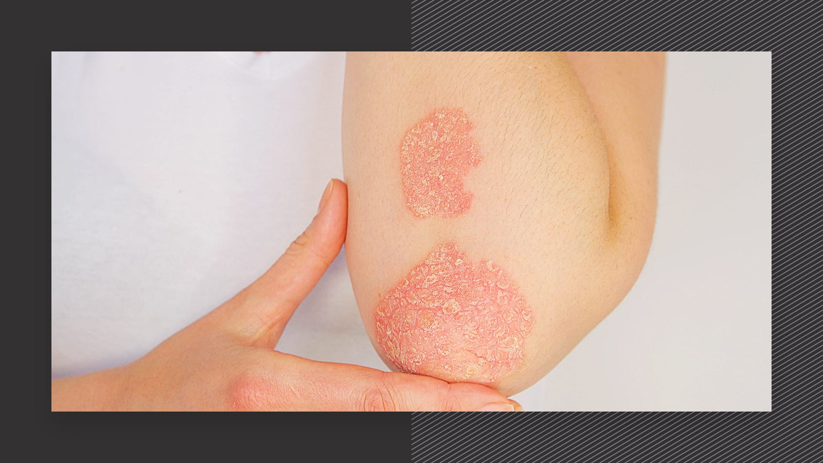 Psoriasis and laser hair removal