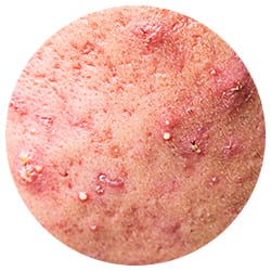 Active acne may limit laser in some areas of the skin