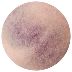 Bruising can affect laser