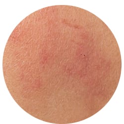 Eczema is a skin condition that can effect laser