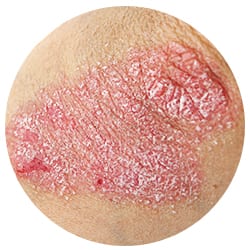 Psoriasis is a skin condition