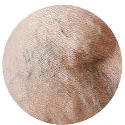 Varicose Veins