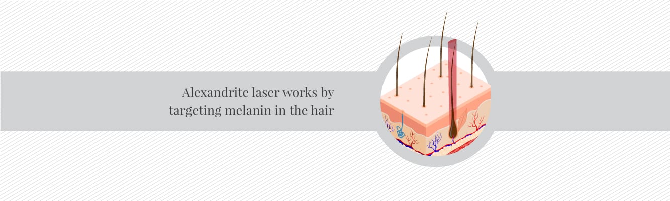 How laser hair removal works on pale skin types