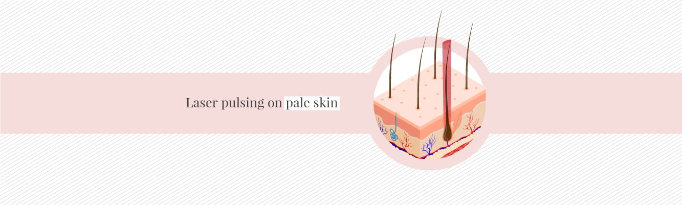 How laser hair removal pulses on pale skin
