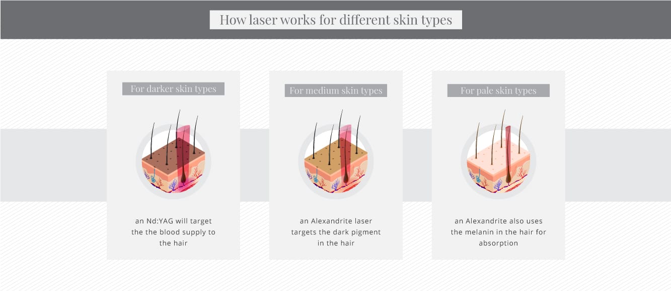 How laser hair removal works for different skin types