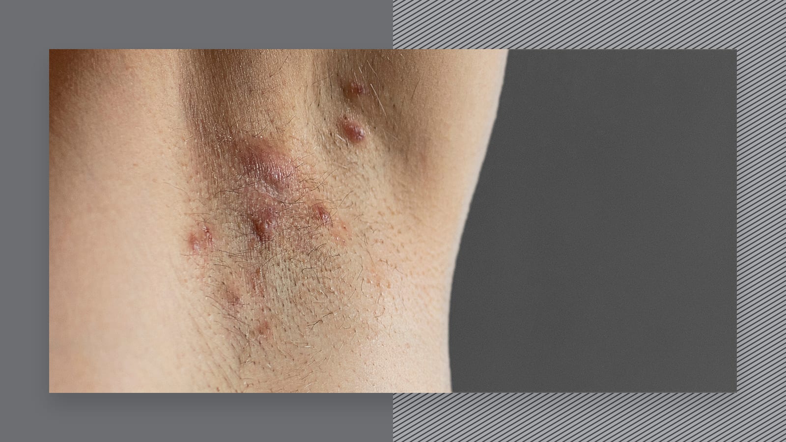 Scarring and tract healing after laser hair removal : r/Hidradenitis