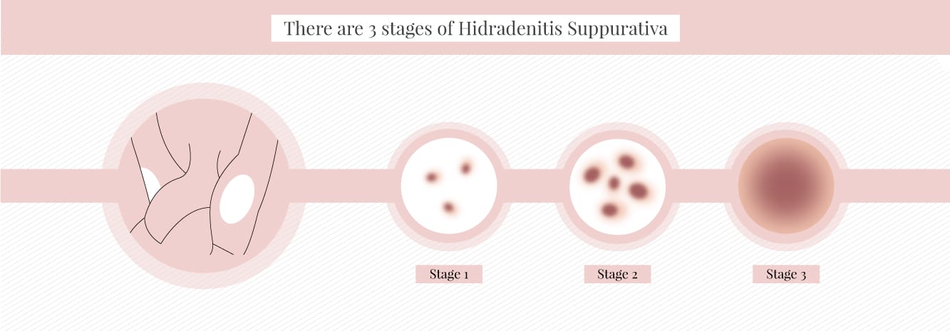 3 stages of hidradenitis suppurativa and what stages are suitable for laser hair removal 