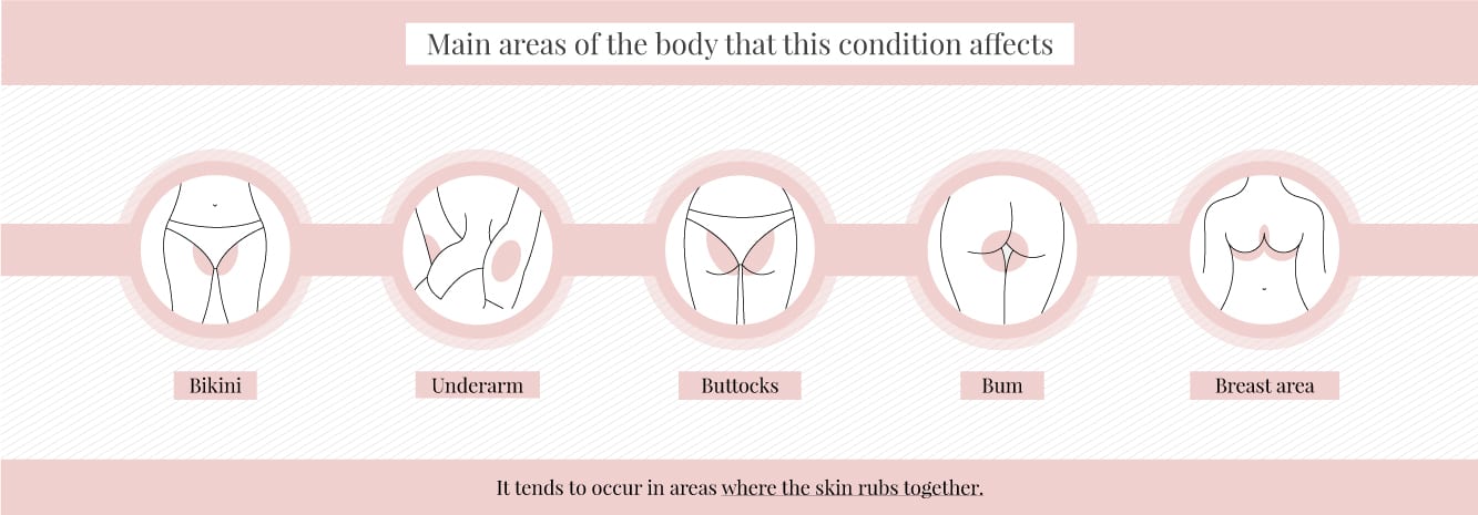 Main areas on the body that are affected by hidradenitis suppurativa
