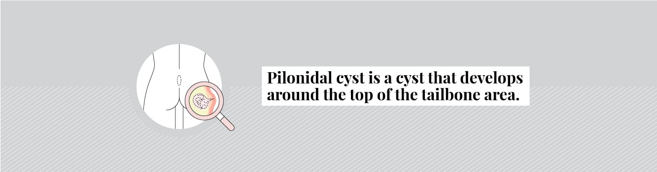 What is a pilonidal cyst and where on the body are they found