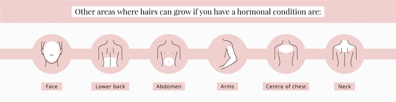 Areas where hair can grow if you have a hormonal condition