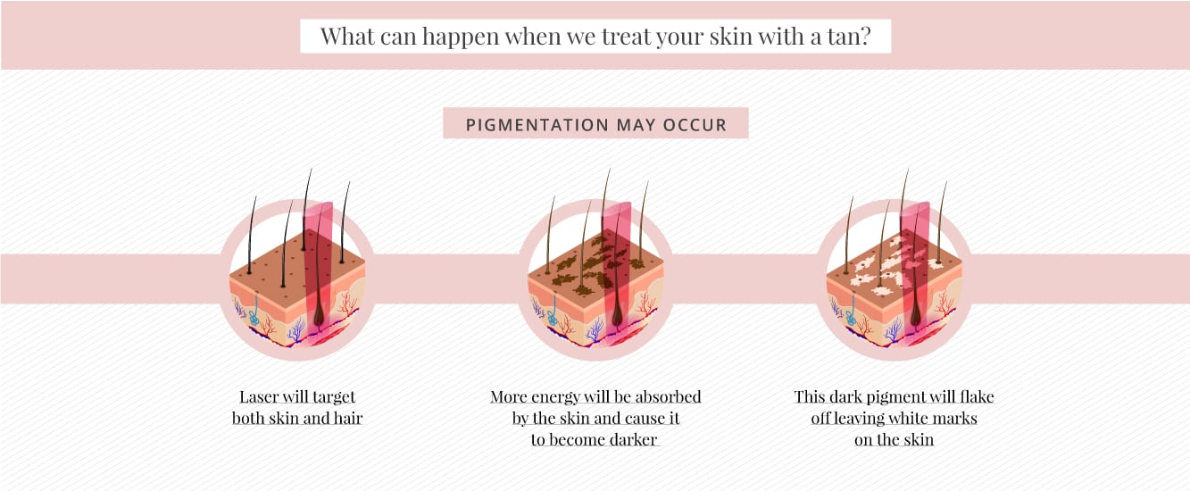 What can happen after laser if you develop a tan